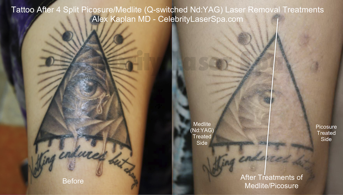 Types of Tattoo Lasers